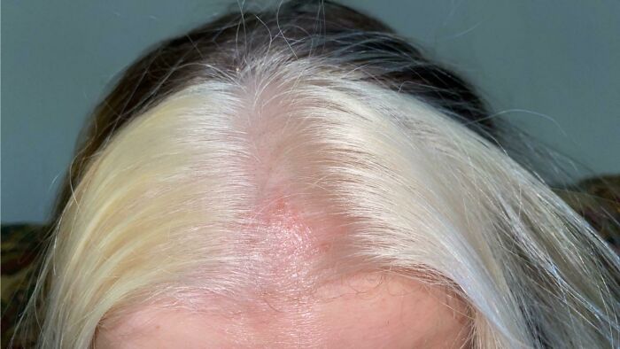Mi peluquera, durante mi cita, tenía otro cliente y me dejó decolorante en el pelo durante más de una hora. Ahora tengo quemaduras químicas y no me da ningún consejo