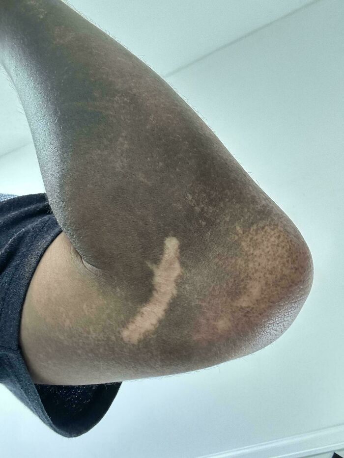 La cicatriz de mi brazo no se ensucia