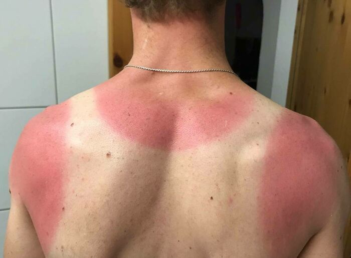 Se me olvidó ponerme protector
