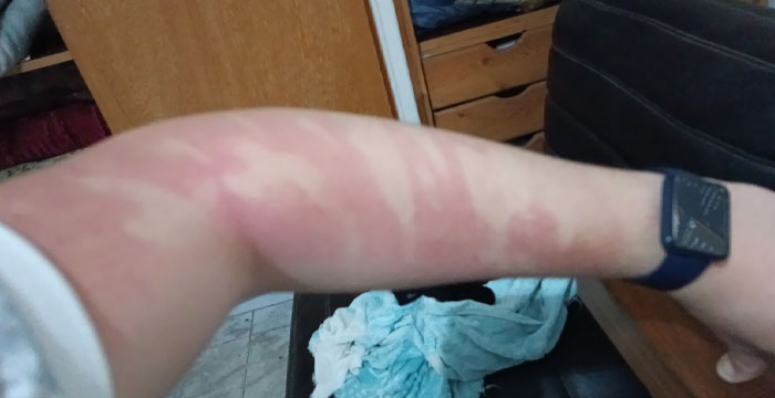 Me puse protector en la cara y luego me sequé el resto en el brazo