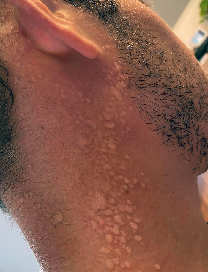 La quemadura solar que me hice hace unos días empezó a pelarme la piel. Hoy salí a correr y todo el sudor quedó atrapado debajo de la piel muerta y se formaron muchas burbujas de sudor.