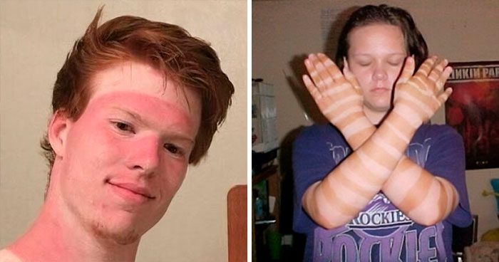36 Personas que metieron la pata tomando el sol y han aprendido la lección