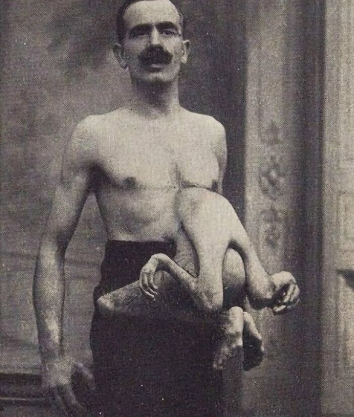 Jean Libbera, alias «El hombre de doble cuerpo», tenía a su hermano parásito, Jacques Libbera, conectado a él desde la zona torácico-estomacal.