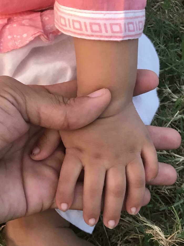 Mi sobrina tiene 6 dedos en ambas manos