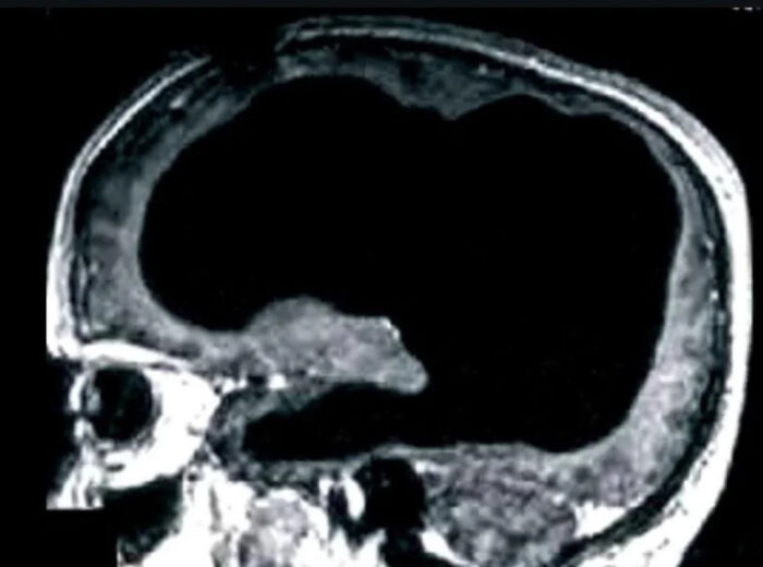 Escáner cerebral mostrando una imagen extrañamente aterradora de un cráneo con vacío sorprendente.