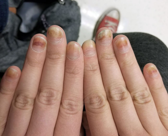 Mis uñas expulsando la quimio de mis dedos