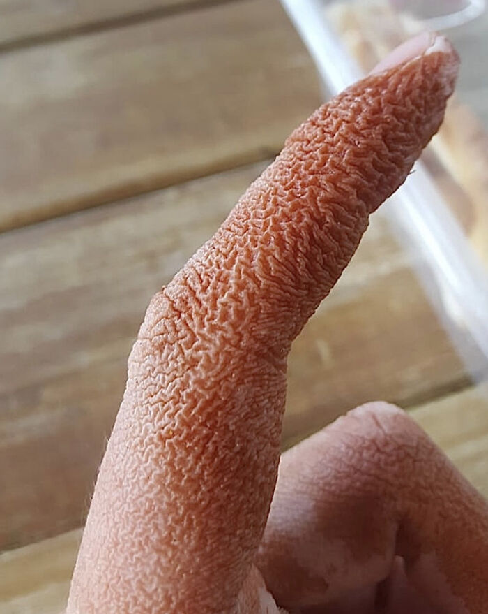 Dedos extremadamente arrugados después de recoger mangos sin guantes