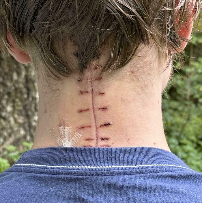 Cicatriz de cirugía de fusión cervical 2 semanas después de la operación