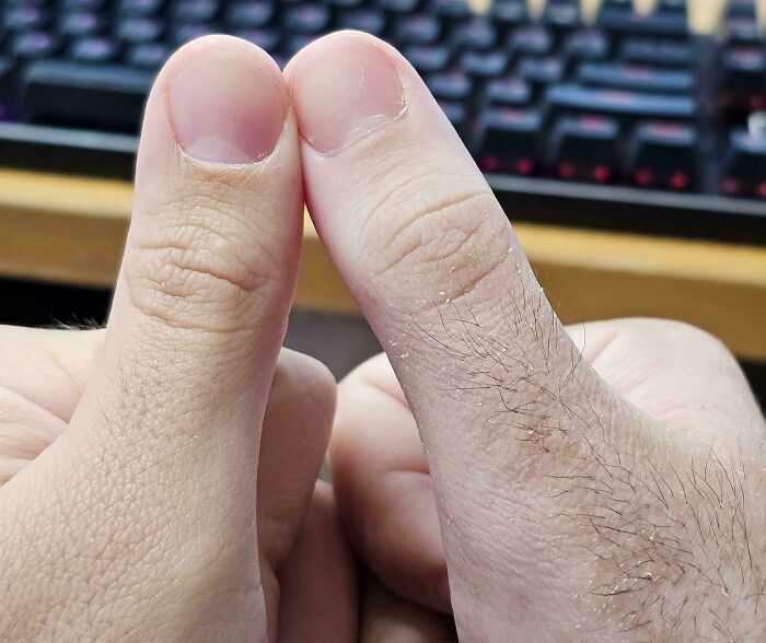 Mi pulgar derecho, que estuvo escayolado durante un mes, se ha vuelto mucho más peludo que el izquierdo.