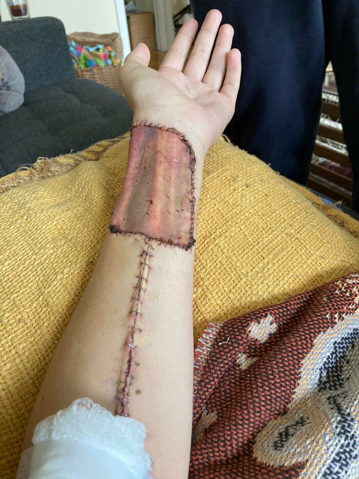 Ligeramente gore. Injerto de piel transparente a la novia de mi hermano. A la m*erda el cáncer