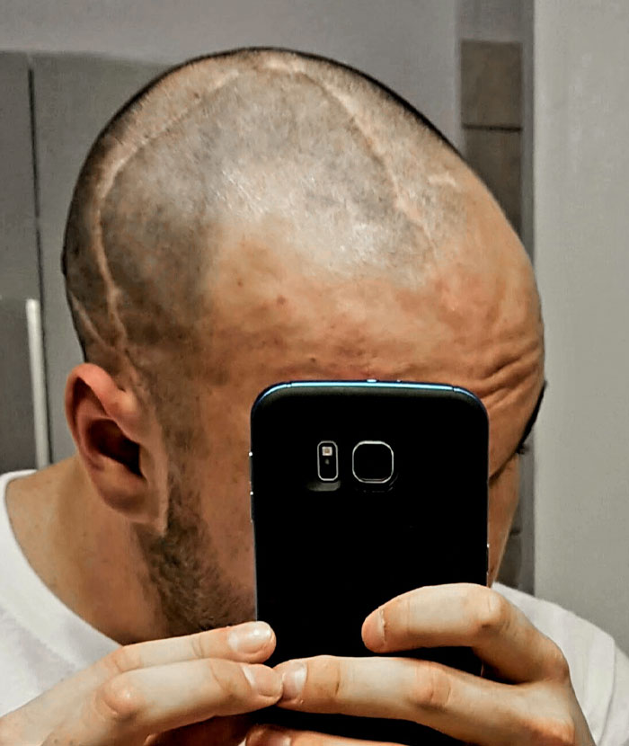 Cicatrices de cirugía cerebral en la parte superior de la cabeza