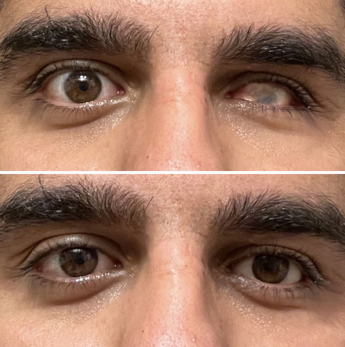 Antes y después de ponerme mi ojo de cristal