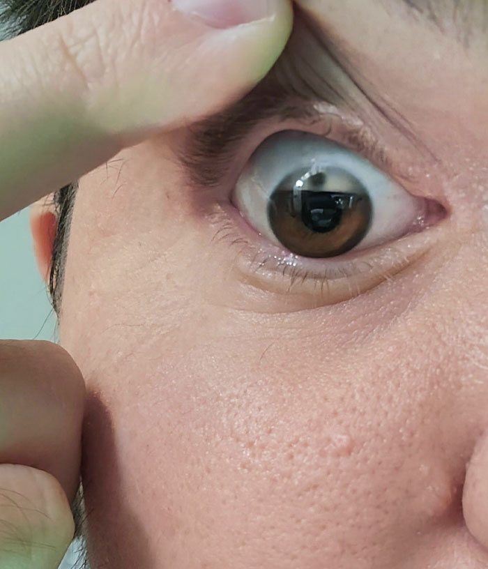 Mi ojo está perdiendo el color poco a poco