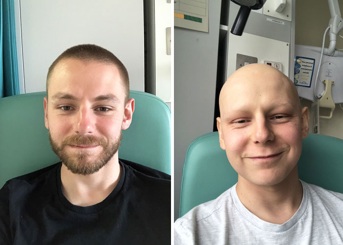 Antes y después de 3 meses de quimioterapia
