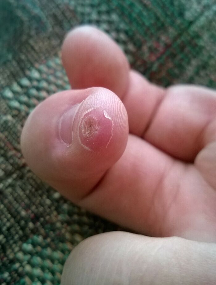 Hace dos semanas me corté limpiamente la punta del dedo con una mandolina. Hoy, puedes ver cada capa de piel curándose por separado...