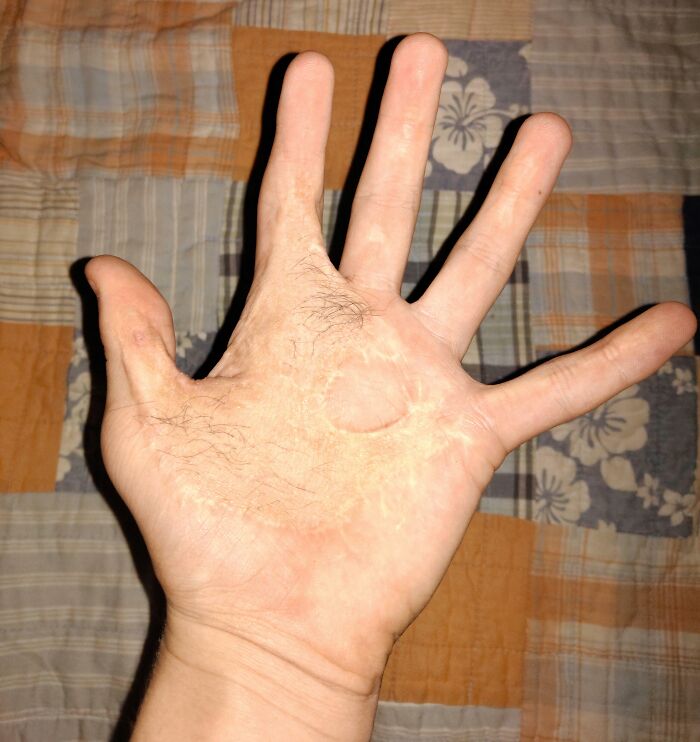 Me quemé la mano con una plancha a la edad de 1,5 años. Esta es mi mano casi 14 años después. Sí, eso es pelo en mi mano