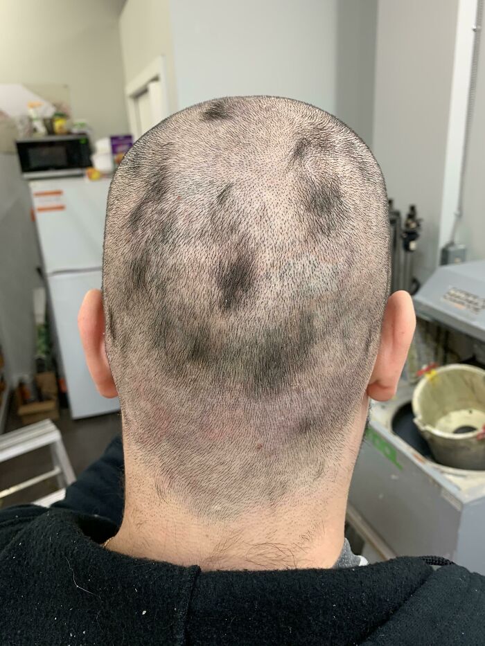 Mi primer intento de “rasurarme” la cabeza. Fui al trabajo así durante dos días y no me di cuenta de ello hasta que un compañero me preguntó si yo estaba bien