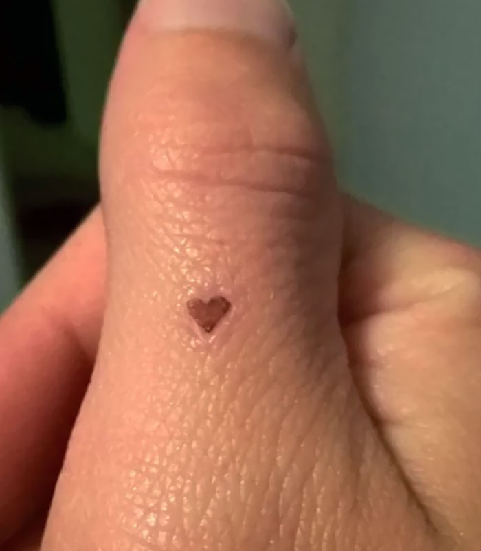 Mi heridita ha curado con una costra en forma de corazón