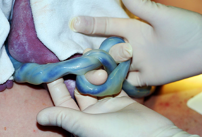 Cuando nació mi hijo tenía un nudo en el cordón umbilical