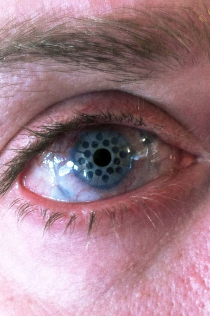 El ojo de mi tío se cura tras un trasplante de córnea
