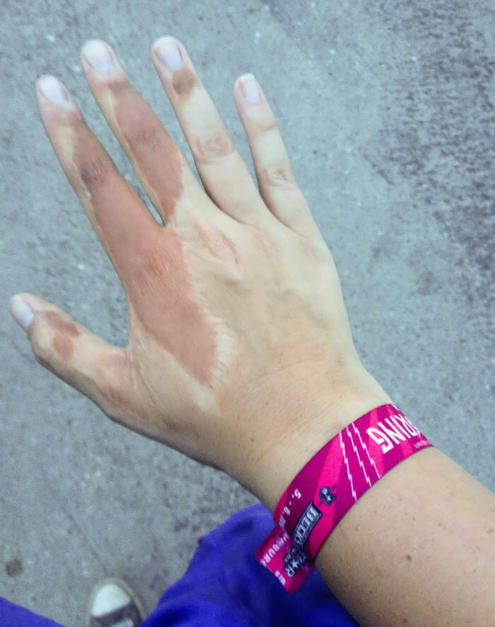 La cicatriz de mi mano, de un trasplante de piel de la parte superior del brazo, se broncea más que el resto