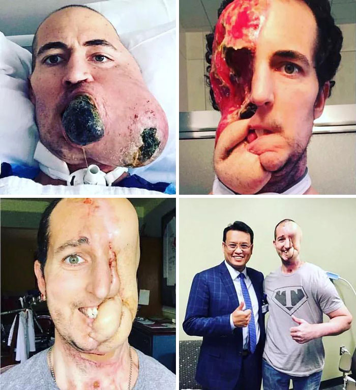 Este hombre llamado Tim tenía un tumor canceroso que había crecido hasta el tamaño de un melón y se lo reconstruyó un cirujano pionero