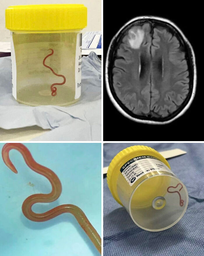 Un neurocirujano extrae un gusano vivo de 8 cm del cerebro de una mujer