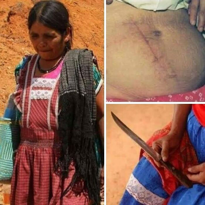Esta mujer se practicó a sí misma una cesárea tras sufrir durante el parto y no tener acceso a atención médica inmediata. Tanto ella como el bebé sobrevivieron.