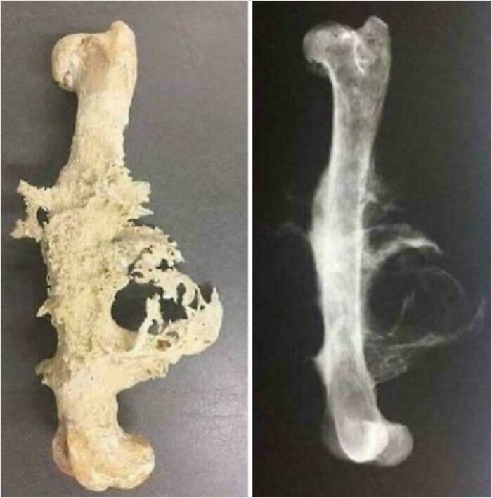 Osteosarcoma