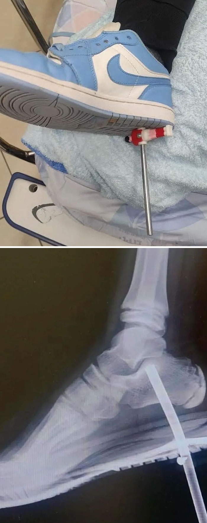 Este joven paciente pisó un poste de futbolín, el poste penetró en la planta de su pie atravesando el zapato y el calcetín.