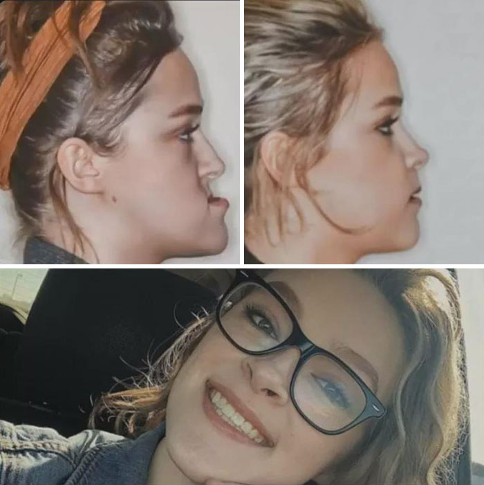 Antes y después de una cirugía ortognática