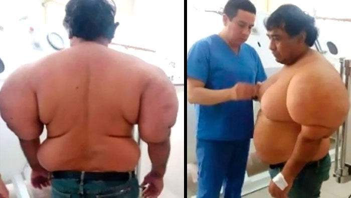 En Perú, un hombre sufrió una inusual hinchazón, parecida a la de un globo, tras un accidente de pesca. Tras una expedición de buceo en busca de marisco, tuvo que volver rápidamente a la superficie porque la hélice de un gran buque comercial le cortó el suministro de aire comprimido.