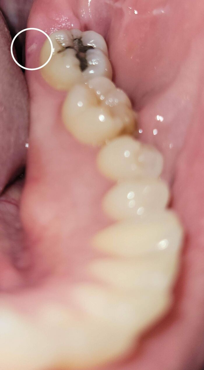 Primer plano de diente con caries y encías inflamadas en imagen médica fascinante y perturbadora.