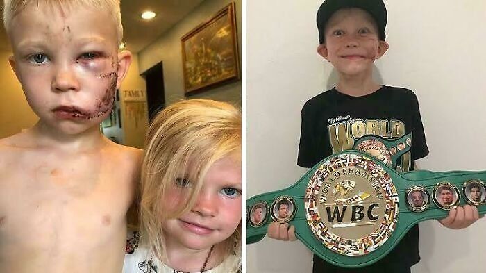 Niño con cicatriz junto a niña, y luego sosteniendo cinturón de campeón, representando un suceso increíble.
