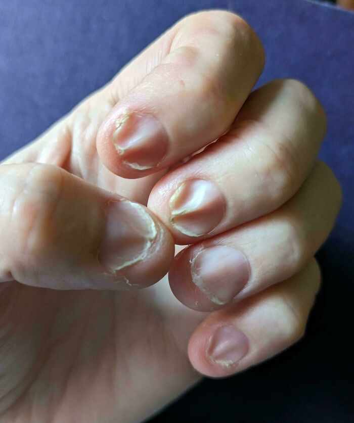 Mano con uñas dañadas y piel seca, mostrando descamación y desgaste, causando una impresión incómoda.