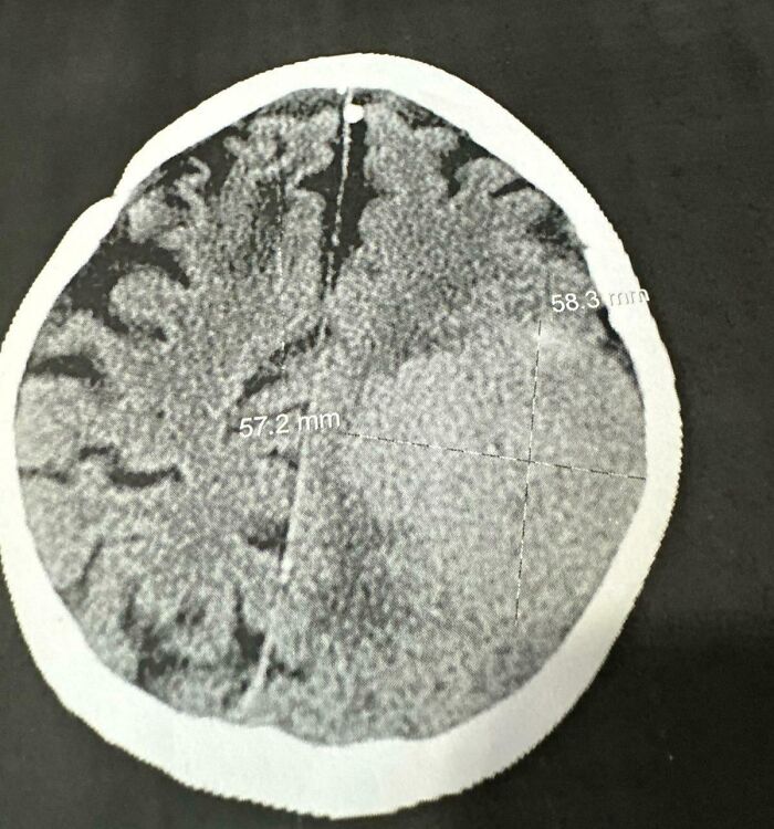 Mi tía se cayó el lunes en el trabajo y en el escáner que le hicieron para comprobar si tenía una conmoción cerebral le encontraron una masa de 6 cm x 6 cm en el cerebro.