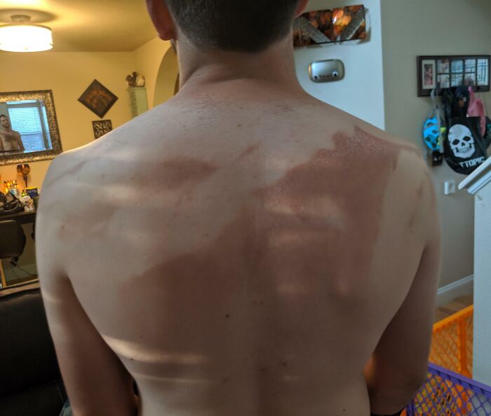 Espalda quemada por el sol con marcas de camiseta en una habitación doméstica; ejemplo de errores dignos de internet.