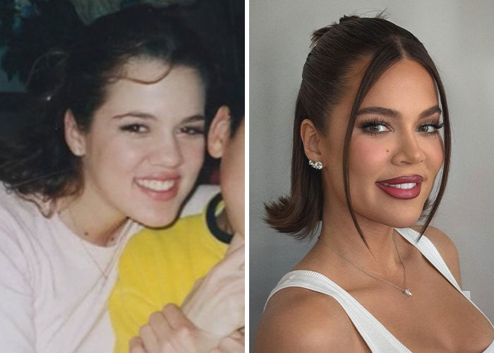 Una celebridad antes y después de cirugía plástica, mostrando sus efectos.