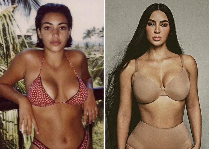 Joven celebridad antes y después de cirugía plástica, mostrando sus efectos notables.