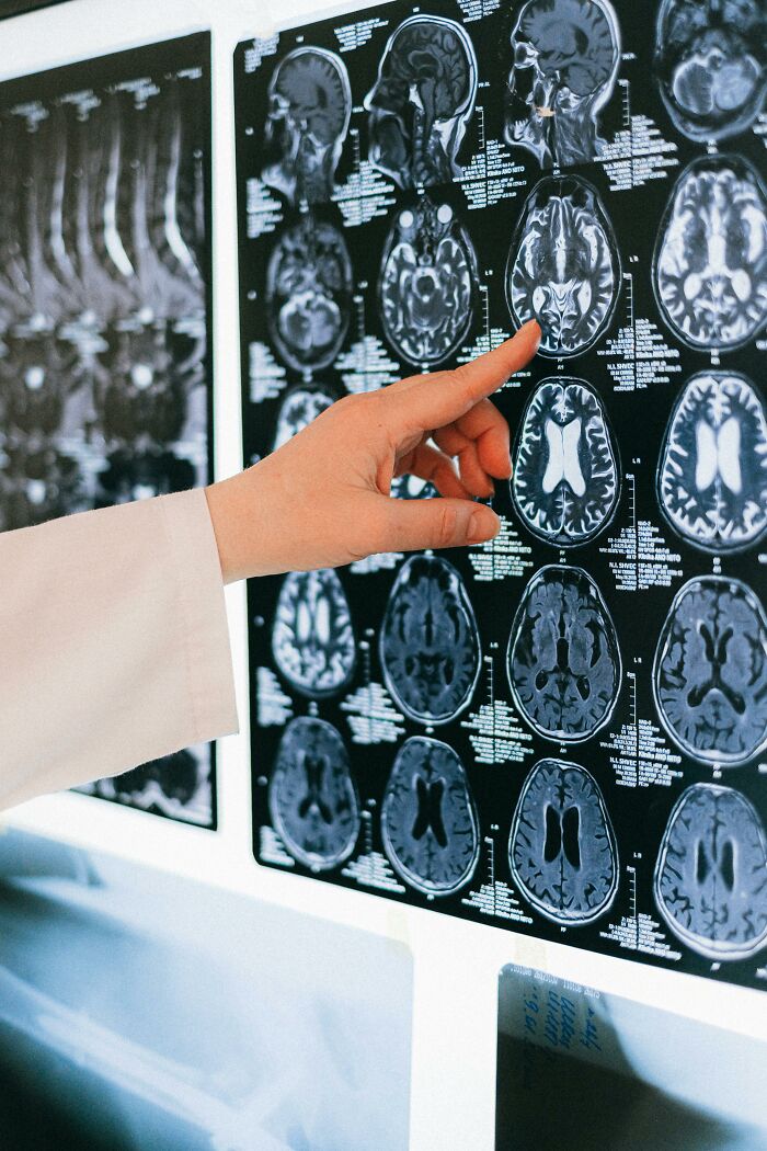 Dedo señalando resonancia magnética cerebral, ejemplificando descubrimiento de parejas 