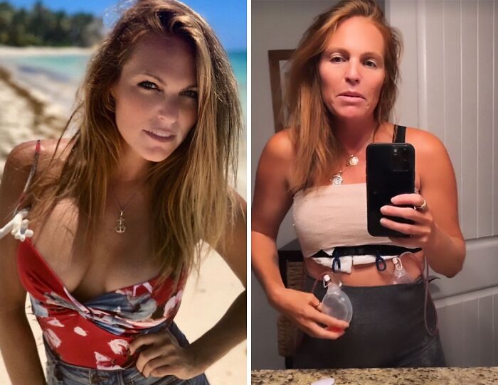 Mujer antes y después de quitarse los implantes de pecho, mostrando resultados de celebritades sin cirugía.