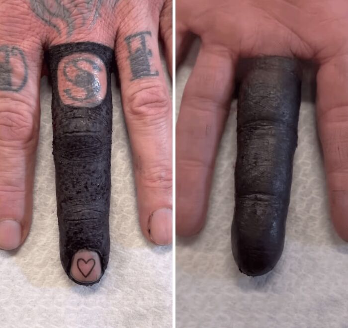 Tatuaje de dedo completamente cubierto en negro mostrando un diseño que fue una mala elección de tatuajes.