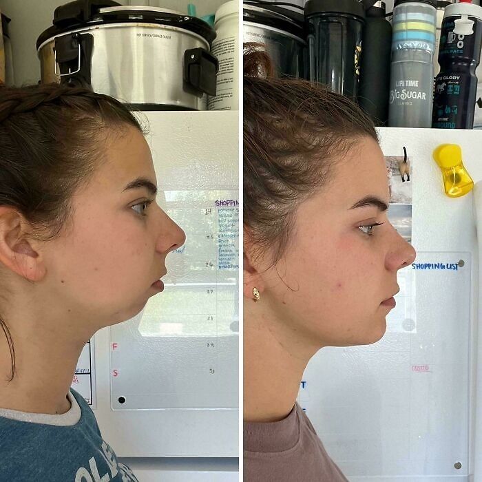 Perfil lateral de mujer mostrando pequeños cambios de apariencia que marcaron la diferencia en su rostro.