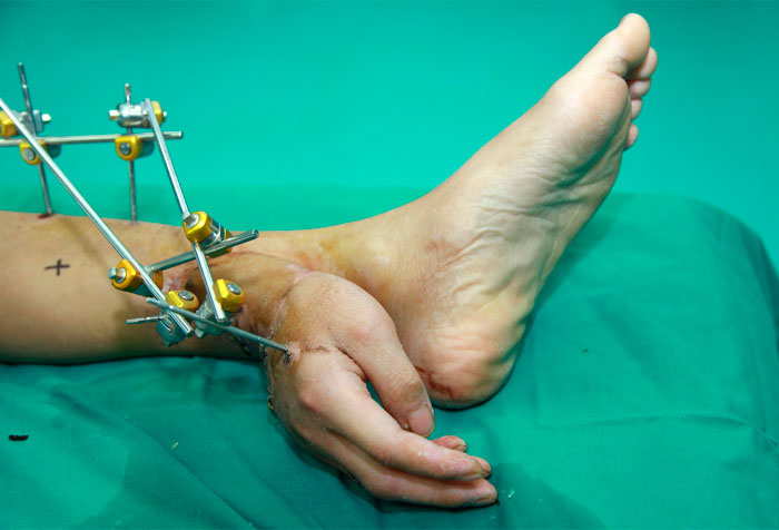 Mano con fijador externo ortopédico en cirugía compleja, ejemplo de fotos médicas que muestran lo aterrador del cuerpo humano.