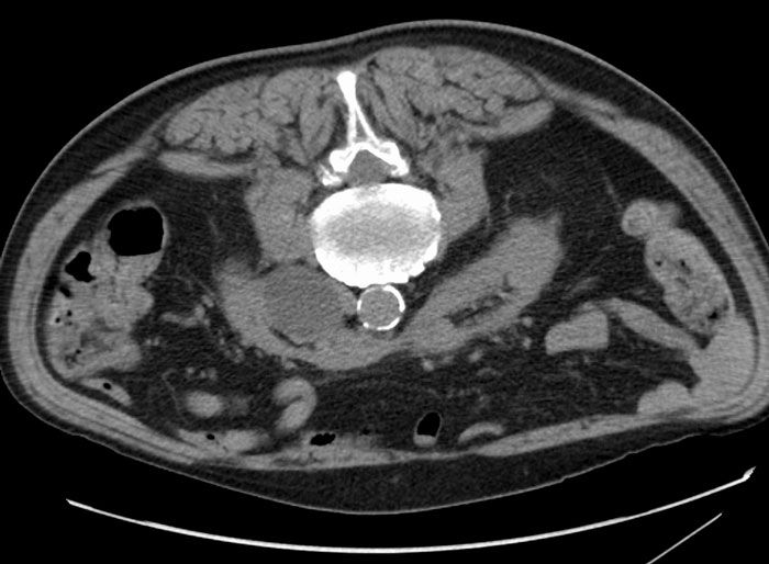Imagen de tomografía axial computarizada mostrando hallazgos médicos raros según expertos en autopsias.