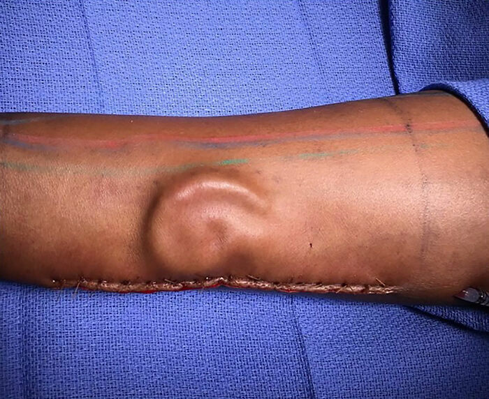 Brazo con formación en la piel que parece una oreja, foto médica impactante del cuerpo humano aterrador.