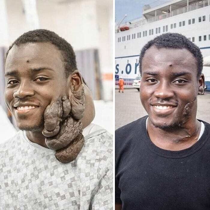 Hombre con tumor médico gigante en la cara y su recuperación, mostrando fotos médicas fascinantes e inquietantes.