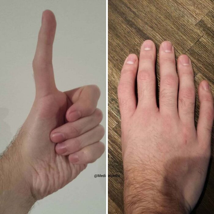 Mano con dedo inusualmente largo y fotos médicas fascinantes mostrando detalles anatómicos inquietantes.