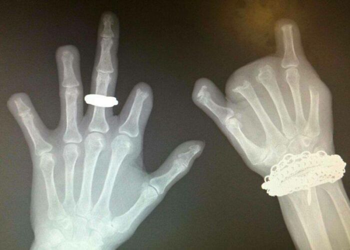 Radiografía de manos con detalles curiosos en anillo y pulsera, mostrando imágenes interesantes del cuerpo humano.