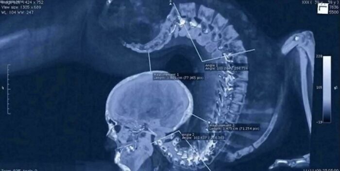 Radiografía con detalle del cuerpo humano mostrando la columna vertebral, cráneo y parte del sistema óseo.